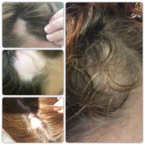 Alopecia and me - regrowing my hair